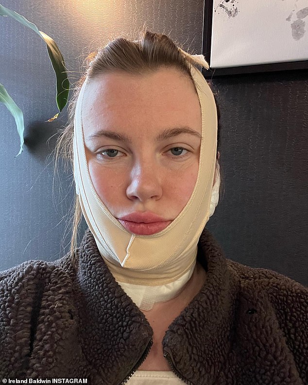 The Healing: In a new Instagram video posted on Tuesday afternoon, the 26-year-old model explained that FaceTite is a minimally invasive, hour-long in-office procedure that doesn't even require anesthesia.